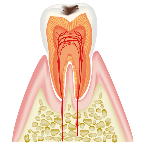 歯の表面に小さなむし歯ができます