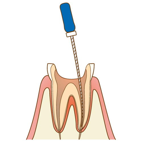 徹底した根管治療