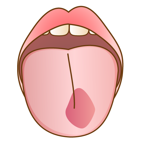 舌の異常