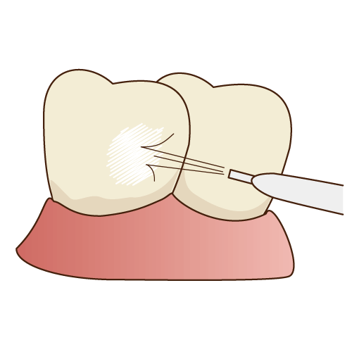 歯間や歯面をクリーニング
